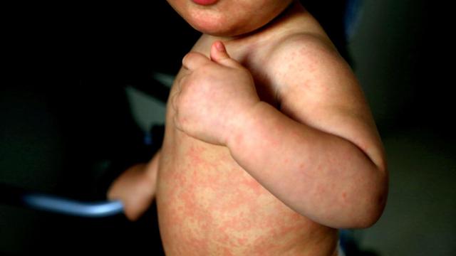 Measles outbreak kills child in Liverpool as vaccination rate plunges - Measles outbreak kills child in Liverpool as vaccination rate plunges
