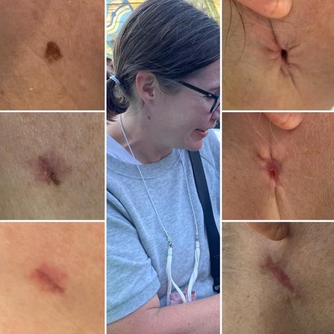 Grid of photos with the original photo of a woman with a neck with a suspicious mole and the left side is the progress photos of mole to biopsy to healed biopsy and the right side is the actual cancer removal from butthole scar to healing to less butthole scar.