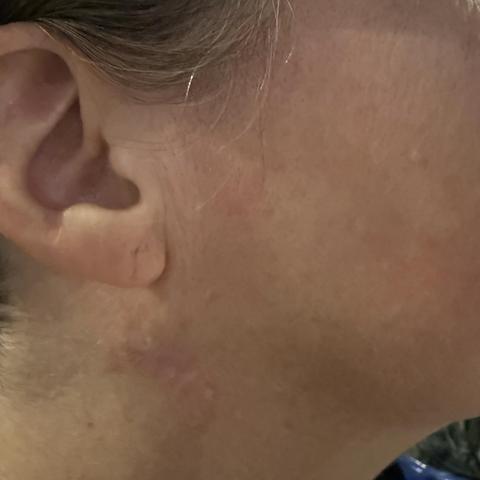 Scar from a mole/skin cancer removal on the neck that initially looked straight up goatse.