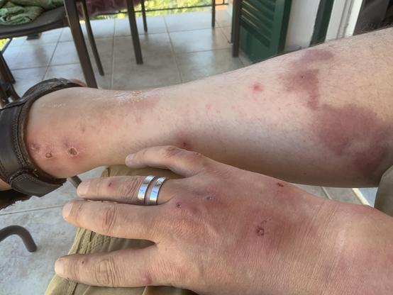 Purple blotches and bites on hands and legs.