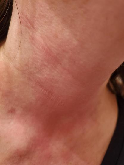 Wallflower's neck very dry, very red, rash, bumps, marks