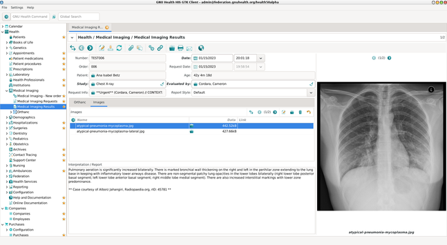 Screenshot from GNU Health Hospital Information System showing a Medical imaging result. 
The patient (our fictious Ana betz) demographics on the center. On the left, the actual x-ray image and the radiologist interpretation at the bottom.
"Pulmonary aeration is significantly increased bilaterally. There is marked bronchial wall thickening on the right and left in the perihilar zone extending to the lung base in keeping with inflammatory lower airways disease. There are non-segmental patchy lung opacities in the lower lobes bilaterally (right lower lobe posterior basal segment; left lower lobe anterior basal segment; right middle lobe medial segment). There are also increased interstitial markings with lower zone predominance.

** Case courtesy of Alborz Jahangiri, Radiopaedia.org, rID: 45781 **

"