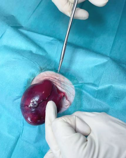 The tumor