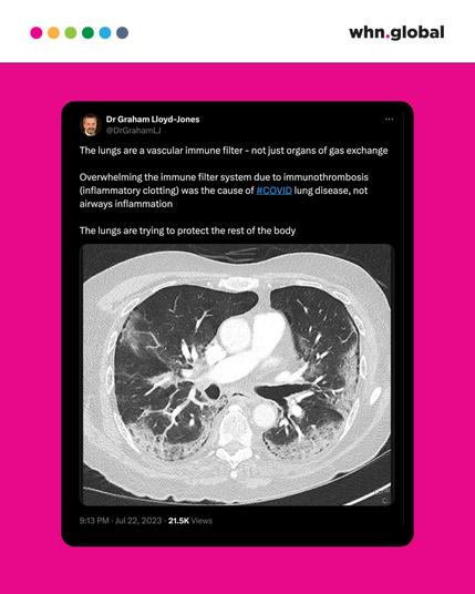 A screenshot of a tweet by Dr. Graham Lloyd-Jones. The tweet reads: "The lungs are a vascular immune filter – not just organs of gas exchange. Overwhelming the immune filter system due to immunothrombosis (inflammatory clotting) was the cause of #COVID lung disease, not airways inflammation. The lungs are trying to protect the rest of the body." The image is a CT scan of a patient's lungs.