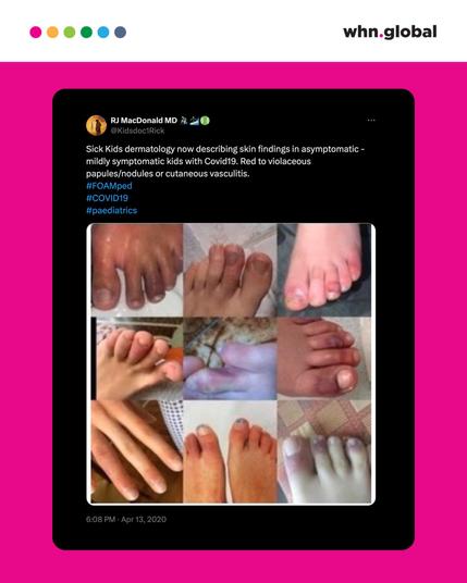 A screenshot of a tweet by RJ MacDonald, MD. The tweet reads: "Sick Kids dermatology now describing skin findings in asymptomatic - mildly symptomatic kids with Covid19. Red to violaceous papules/nodules or cutaneous vasculitis. #FOAMped #COVID19 #paediatrics." The image shows a collage of pediatric COVID-19-related skin findings on toes and feet.
