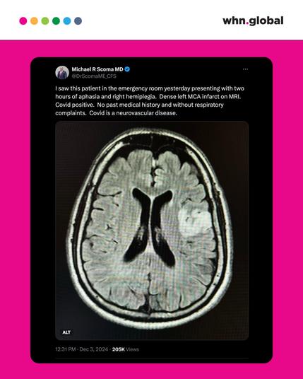 A screenshot of a tweet by Michael R. Scoma, MD. The tweet reads: "I saw this patient in the emergency room yesterday presenting with two hours of aphasia and right hemiplegia. Dense left MCA infarct on MRI. Covid positive. No past medical history and without respiratory complaints. Covid is a neurovascular disease." The image shows a brain MRI highlighting the infarct area.