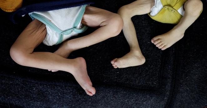 Palestinian children suffering from malnutrition receive treatment at a healthcare center, in Rafah, in the southern Gaza Strip, March 4, 2024.