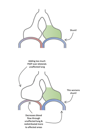 Two alveoli diagram showing how application of excessive PEEP can worsen shunt physiology.