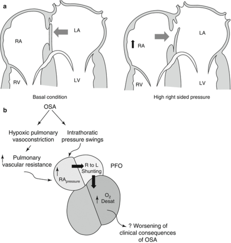 Shunt through a PFO occurs when right sided pressures rise