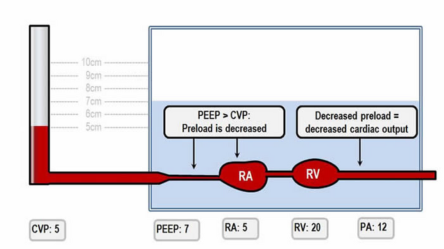 Great visual explanation of how PEEP effects preload and decreased cardiac output. From deranged physiology