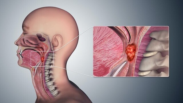 An anatomical cutaway illustration of the human mouth, pharynx and esophagus showing the location of oropharyngeal cancers
