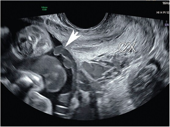 transvaginal ultrasound image of vasa previa (arrow), cx - cervix