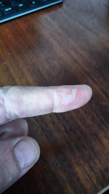 Foto meiner linken Hand. Zu sehen ist mein gestreckter Zeigefinger, an dessen rechter Flanke eine etwa ejn mal zwei Zentimeter große Brandblase zu sehen ist. Daumen und gebeugter Mittelfinger sind auch zu sehen. Im Hintergrund eine dunkle Holzplatte.
