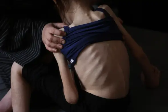 Shuruq Ayyad exposes the protruding ribs of her 12-year-old daughter Rahaf at a school turned shelter at al-Rimal in central Gaza City. Amnesty International accused Israel this week of committing a ‘livestreamed genocide’ against Palestinians by forcibly displacing people from Gaza and creating a humanitarian catastrophe in the besieged territory, claims Israel dismissed as ‘blatant lies’

Photograph: Omar Al-Qattaa/AFP/Getty Images
