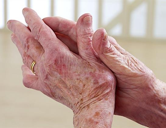 Common anti-inflammatory drugs may aid virus spread