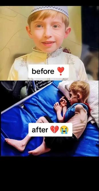 Before and and after images of a Palestinian child severely malnourished because of Israeli blockade of Gaza