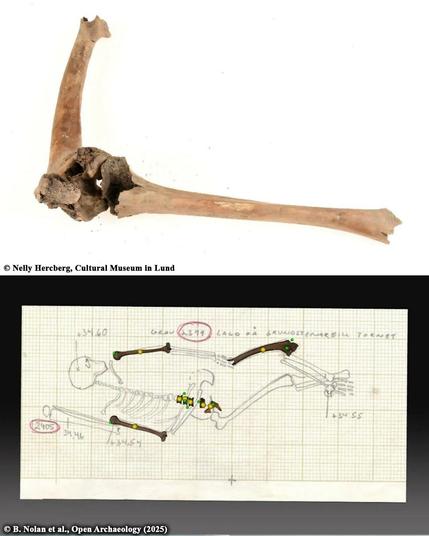 Medieval man with crippled knee reveals disability care in Sweden

A recent archaeological study in southern Sweden has revealed new insights into the medieval disability experience. The study by Lund University researchers has examined a skeleton belonging to a man who had a disabling knee injury, revealing both the harsh realities and the unexpected compassion that characterized medieval disability attitudes.

Published in Open Archaeology, the study centers on “individual 2399,” a man in his mid-30s who lived between 1300 and 1536 CE. His skeleton was discovered in Lund, a historic city in southern Sweden. The man had suffered a serious fracture and dislocation of his left knee as the result of some traumatic incident such as a horse kick or a dropped heavy object, presumably on the site where he used to work. This injury made it impossible for him to walk unaided for the rest of his life...