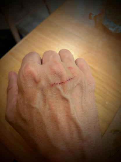 hand with a large scratch, possibly caused by a cat
