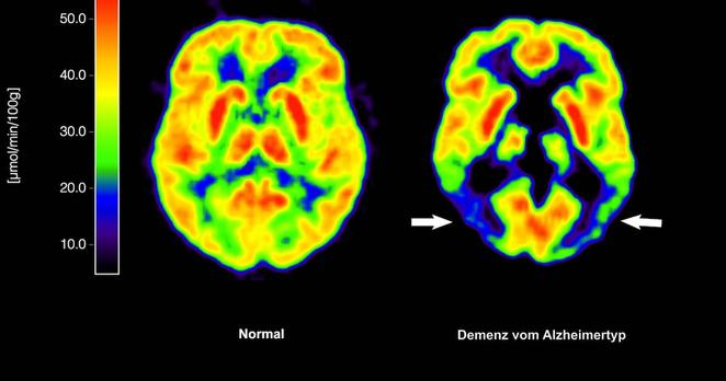 Die mit der Positronen-Emissions-Tomografie (PET) erstellte Abbildung zeigt die Gegenüberstellung zweier Gehirne – im gesunden Zustand (l) und mit Alzheimer-Krankheit (Handout von 2012). Die EU-Kommission hat den Wirkstoff Lecanemab gegen Alzheimer zugelassen.