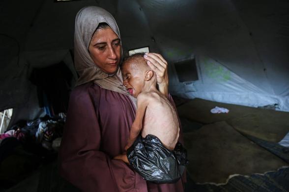 Muhammad Zakaria al-Mutawaq, an 18-month-old child facing life-threatening starvation, July 24, 2025. (Photo: Omar Ashtawy/APA Images)