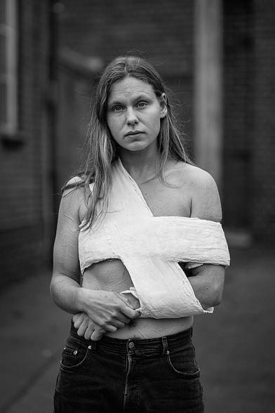 Eine junge Frau in ihren 20ern mit einem Schultergips in einer osteuropäischen Valpeaux-Variante. Viele selbst zugefügte Narben sind auf ihren Armen und ihrem Oberkörper zu sehen, da der Gips nur einen kleinen Teil des Oberkörpers verdeckt.