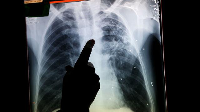 A radiographer in the UK points to an X-ray made for a tuberculosis patient. | Copyright Lefteris Pitarakis/AP Photo