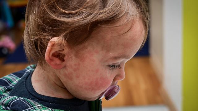 Un enfant atteint de la rougeole.