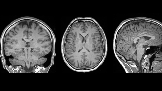 Brain injury breakthrough: New Zealand scientists discover telltale marker after concussion