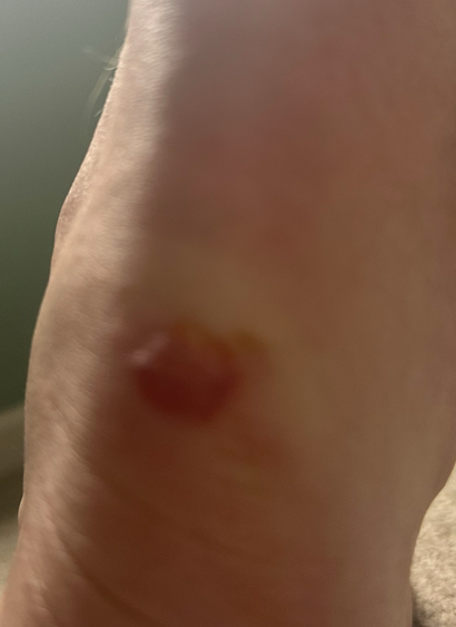 Painful heel blister