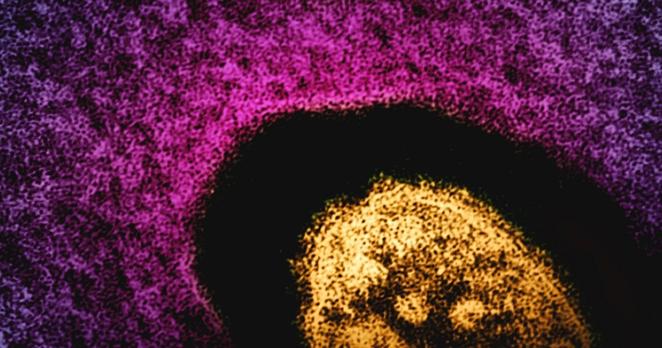 Elektronenmikroskopische Aufnahme eines Masern-Virus, hier gelb angefärbt.
